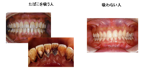たばこと歯の写真